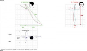 Figure 2. This readout shows the results of a computerized jaw tracking, demonstrating a normal range of motion with the potential protrusion of 9.6 mm.