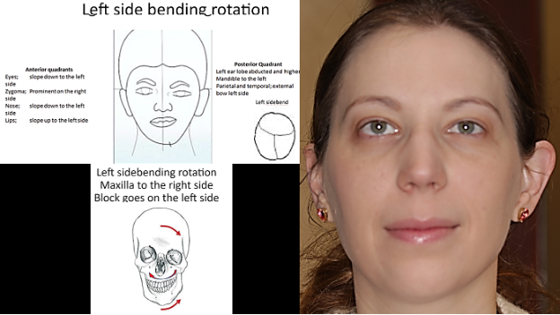 Figure 3 Cranial Strain pictures taken from: Face to Face with the Face By: Thomas Attlee DO, R.C.S.T