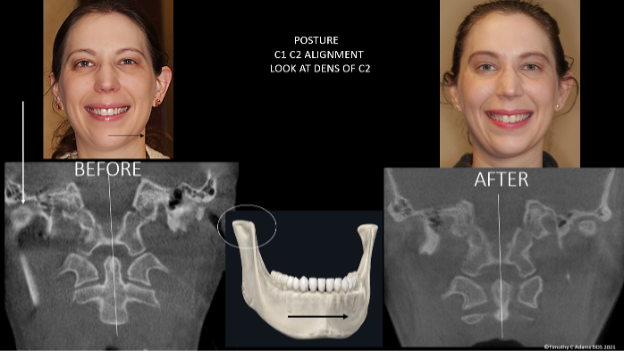 Figure 18 Note how forward the patient’s right condyle is which is a direct result of the left temporal bone being externally rotated (abducted ear) driving the mandible to shift to the left. 20 months after treatment the mandible and condyles are more centered ideally and the ears are now more level as a direct result of the temporal bone being in a more natural position as evidenced by the improvement in the level of the ears and left ear abduction.