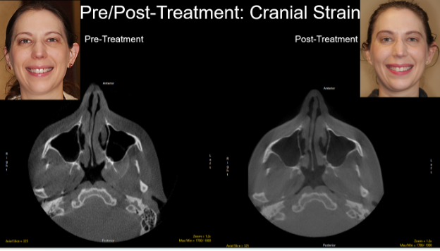 Figure 19 Dramatic improvement in cranial strain pattern.