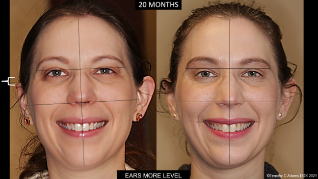 Figure 8 In addition to facial symmetry improvement note the changes in head tilt potentially affecting cervical instability, thus blood flow into and drainage out of brain and the Vagus nerve (parasympathetic).