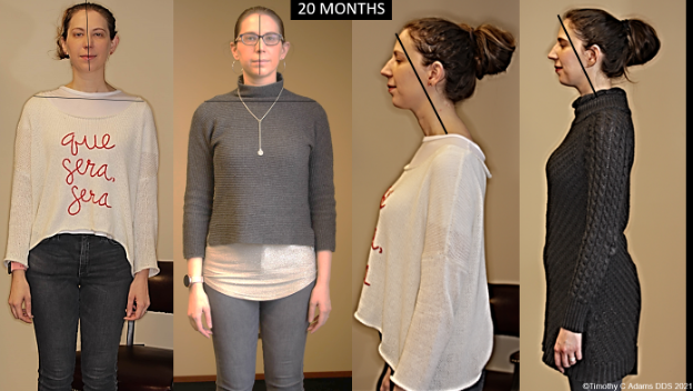 Figure 9 Improvement seen in general posture and forward head posture.